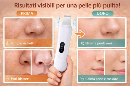 Peeling viso Scrubber Pulizia Viso Ultrasuoni Spatola Punti Neri Professionale